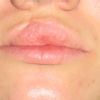 Empfehlung für Lippenreduktion - 26782