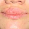 Empfehlung für Lippenreduktion - 26783