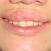 Empfehlung für Lippenreduktion - 26784