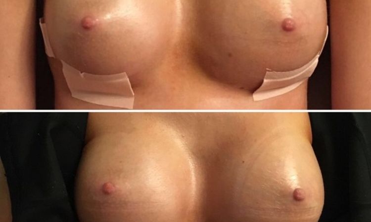 Meinung zur Brustvergrößerung vor 18 Tagen: 300cc, anat. Mentor, UBM - 26807