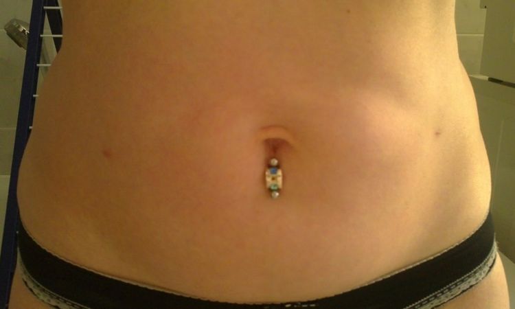 Verhärtung um den Bauchnabel 3 Monate nach Liposuktion - 26815