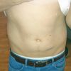 Folgen von Gewichtsschwankungen, 184 cm, 82kg - Fettabsaugung im Kölner Umkreis