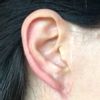 Guter Arzt für Pixie ear Korrektur gesucht - 26869