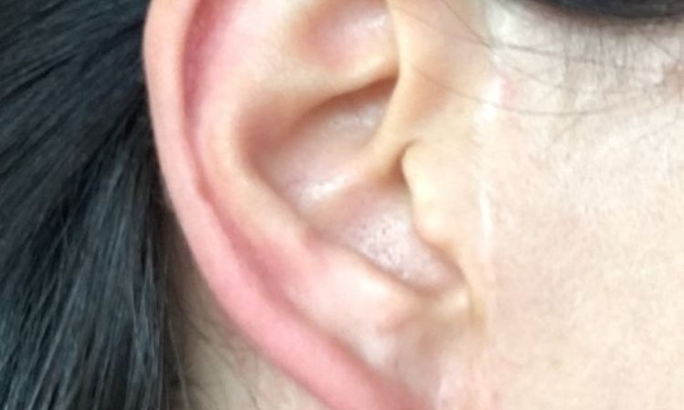 Guter Arzt für Pixie ear Korrektur gesucht - 26869