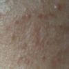Entfernung von Narben nach Kratzwunde mit Peeling oder Laser - 26889