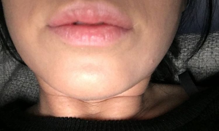 Knubbel und Falte nach Lippenaufspritzung mit Silikon vor 2 Jahren - 26903