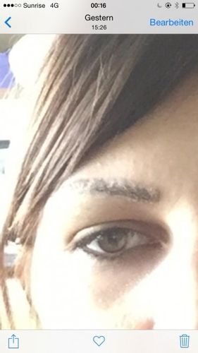 Chirurgische Entfernung des Permanent Make ups