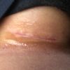Narbe komisch 4 Wochen nach Brust-Op?