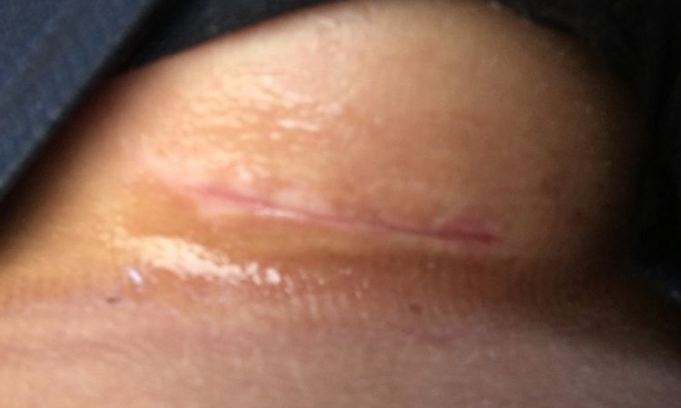 Narbe komisch 4 Wochen nach Brust-Op? - 26927