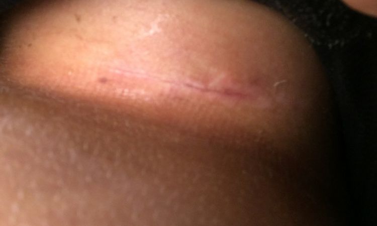 Narbe komisch 4 Wochen nach Brust-Op? - 26928