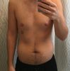 Fettabsaugung an Bauch und Hüfte bei 184 cm und 80 kg - welche Technik?