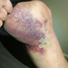 Starke Schwellungen und Hämatome im Kniebereich 7 Tage nach Liposuktion