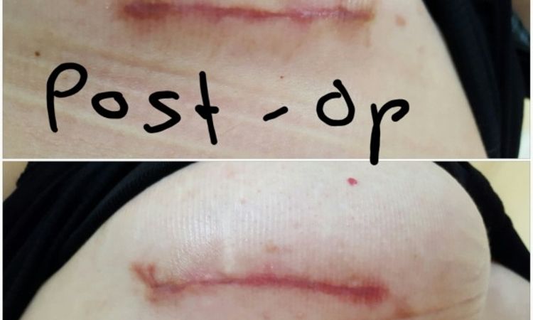 Dunkle Narben und Morbus Mondor 6 Wochen nach BV mit 310 ml runden Impl. von Allergan UBM - 26949