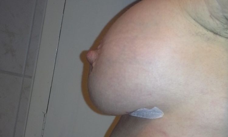 Befundverbesserung 9 Tage nach BV mit runden 295 ml Impl. UBM - 26952