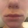 Schwellung 1 Tag nach Lippenbehandlung mit Ellanse - 26954