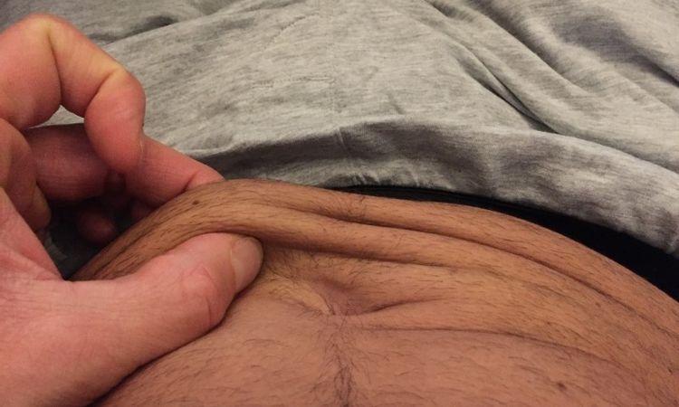 Laser-Fettabsaugung mit Straffung versus Bauchdeckenstraffung - 26958