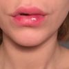 Kleine Knötchen und Schwellung 2 Monate nach Lippenunterspritzung mit Juvederm - 26970