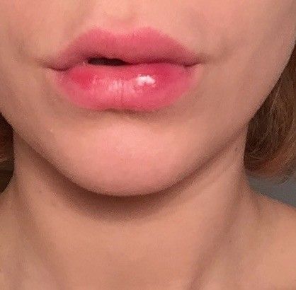 Kleine Knötchen und Schwellung 2 Monate nach Lippenunterspritzung mit Juvederm - 26970