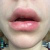 Kleine Knötchen und Schwellung 2 Monate nach Lippenunterspritzung mit Juvederm - 26971