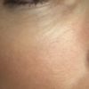 Runzelige Haut und Druck in der Augenhöhle 2 Monate nach Unterspritzung mit Volbella - 26987