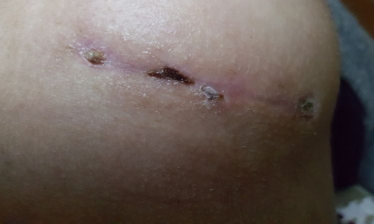 Heilung normal und bügellose BHs 8 Wochen post Brustvergrößerung? - 26988