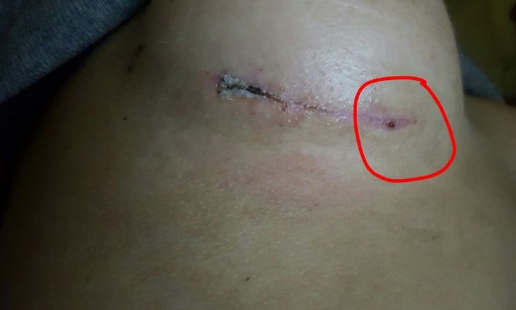 Heilung normal und bügellose BHs 8 Wochen post Brustvergrößerung? - 26989