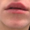 Ungleichmäßige Lippen nach Unterspritzung mit  0,5 ml vor 2 Tagen - 26995