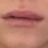 Ungleichmäßige Lippen nach Unterspritzung mit  0,5 ml vor 2 Tagen - 26996
