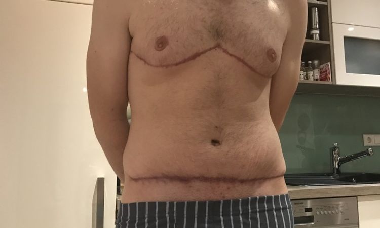 Sixpack nach Bauchdecken- und Bruststraffung sichtbar (M26)? - 27007