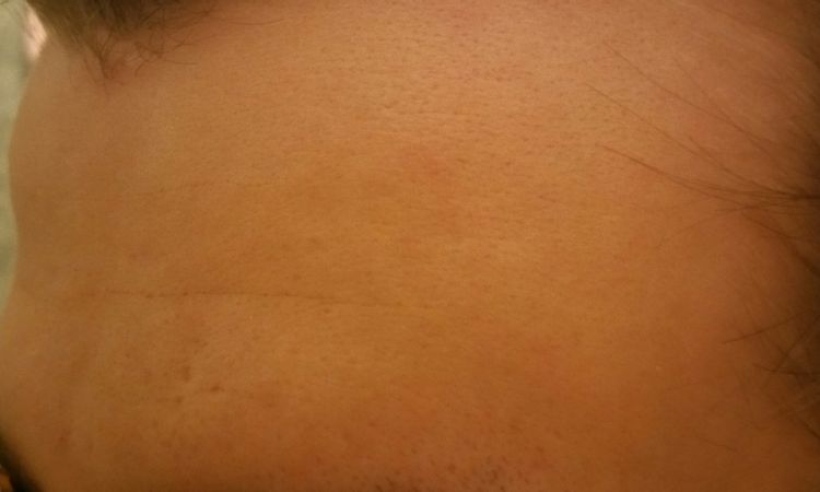 Stirnknochen-Korrektur durch Eigenfett oder durch Abschleifen? - 27011