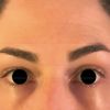 Asymmetrie an den Augen bzw. Brauen durch Botox behandeln? - 27038