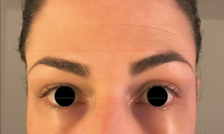 Asymmetrie an den Augen bzw. Brauen durch Botox behandeln? - 27038