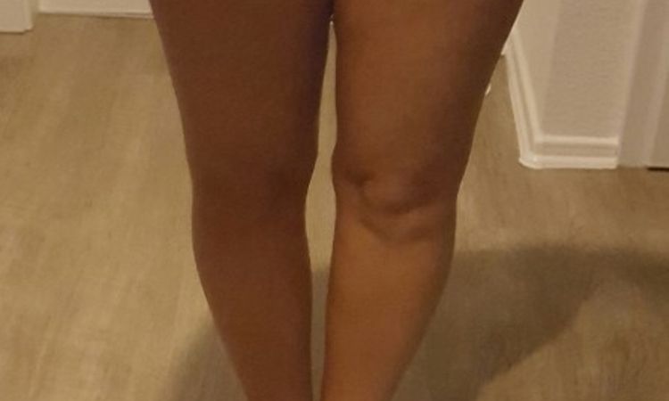 Dellen und Schwellungen 4 Wochen nach Liposuktion an Reiterhosen, Oberschenkeln und Pofalte - 27045