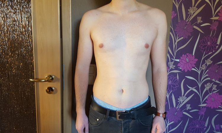 Brust zu groß und zu spitz 6 Monate nach Gynäkomastie-OP - 27048