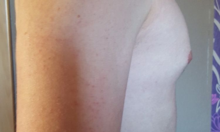 Brust zu groß und zu spitz 6 Monate nach Gynäkomastie-OP - 27049