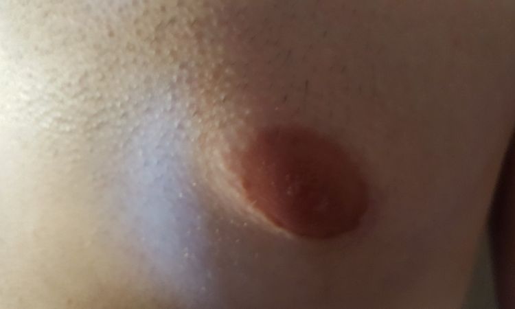 Brust zu groß und zu spitz 6 Monate nach Gynäkomastie-OP - 27050