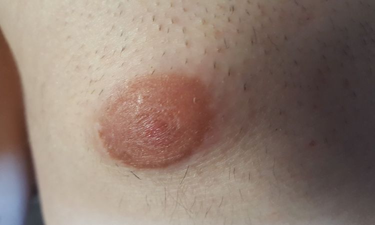 Brust zu groß und zu spitz 6 Monate nach Gynäkomastie-OP - 27051