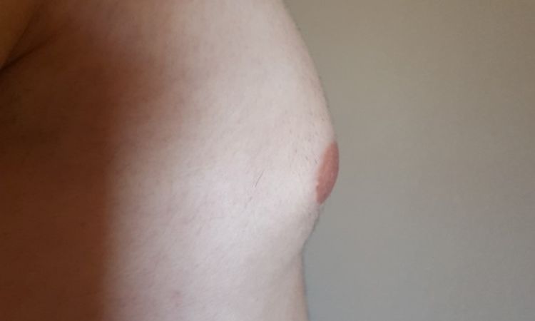 Brust zu groß und zu spitz 6 Monate nach Gynäkomastie-OP - 27052