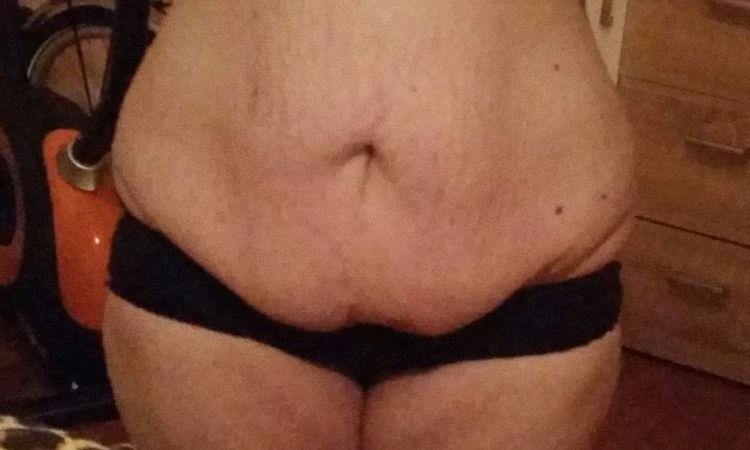 Bauch- und Oberschenkelstraffung: entzündeter Bauchnabel nach Abnahme von 40 kg - 27091