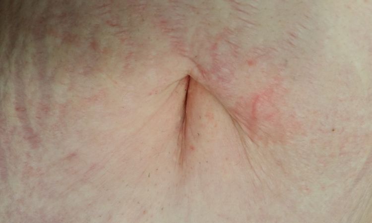 Bauch- und Oberschenkelstraffung: entzündeter Bauchnabel nach Abnahme von 40 kg - 27092