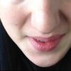 Botoxbehandlung von ausgeprägten Kaumuskeln durch Zähneknirschen - 27103