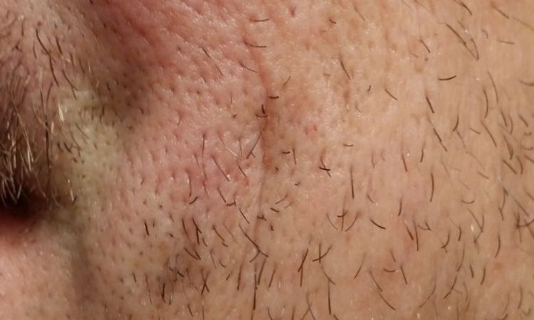 Behandlung der Knitterfalten mit Juvederm Hydrate oder Ultra 2 - 27111