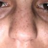 Kosten für Nasenkorrektur: feine Nase
