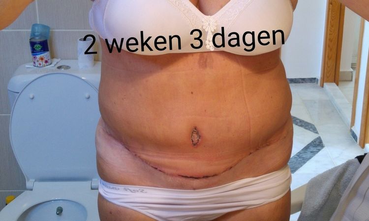 Ödem bei Bauchdeckenstraffung, Lipo und Muskelstraffung vor 3 Monaten - 27144