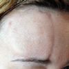 Fadenlifting mit Aptos Fäden auf der Stirn vor 8 Wochen: Beulen und Dellen - 27159