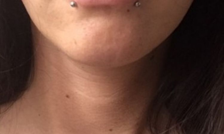 Hylase nach Lippenvergrößerung mit 1 ml Juvederm Ultra 3? - 27172