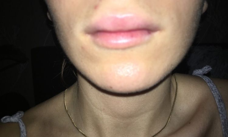 Geschwollene Oberlippe nach Lippenunterspritzung mit 1 ml Hyaluronsäure - 27178