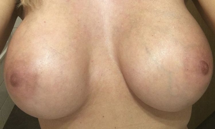 6 Monate post Brustvergrößerung rechte Brust unbeweglich und härter - 27192