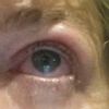 Schwere und angeschwollene Augenlider 4 Wochen nach Oberlidstraffung - 27196