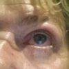 Schwere und angeschwollene Augenlider 4 Wochen nach Oberlidstraffung - 27197